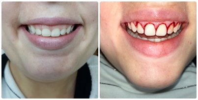 Gengivoplastia , Cirugia da Gengiva por Natali Santos..